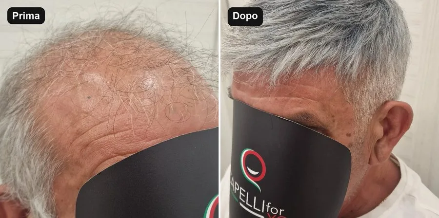 Prima e dopo una protesi a contatto