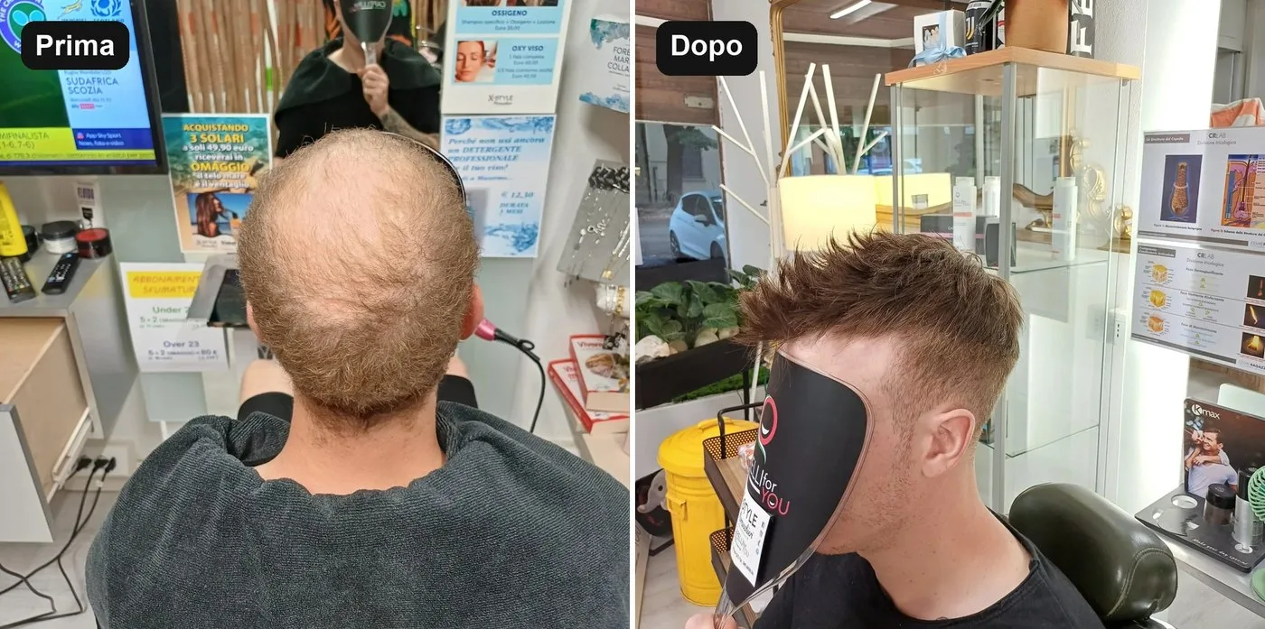 Prima e dopo una protesi capillare da X-Style Parrucchieri