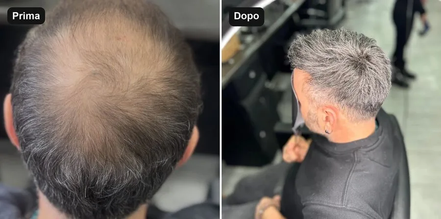 Prima e dopo una protesi capillare uomo