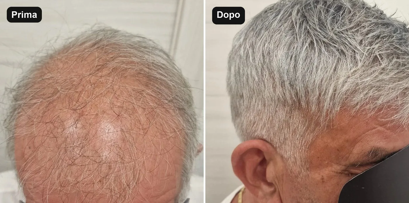 Prima e dopo un infoltimento capillare uomo da X-Style Parrucchieri